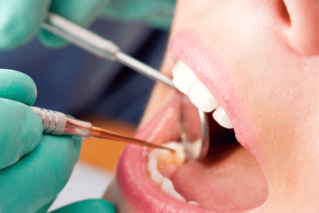 השתלות שיניים - כל מה שרציתם לדעת