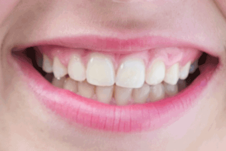 טיפול שיניים בלייזר- קל יותר