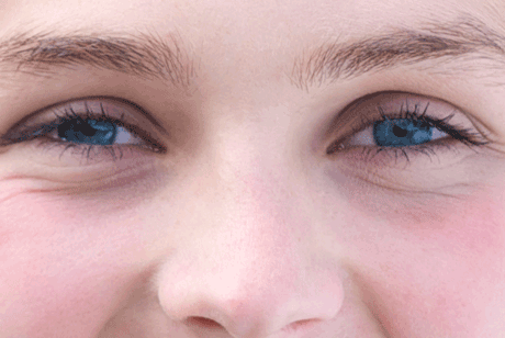 העפעף הנפול מושפע מקפלי העור שסובבים מעל לעין