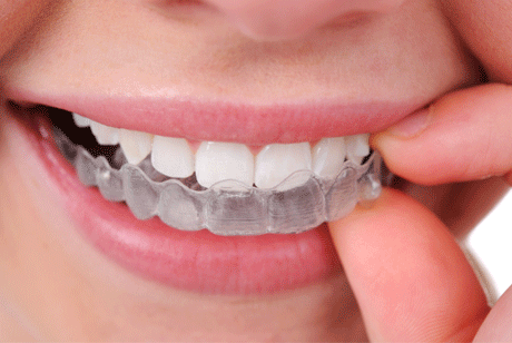 הלבנת שיניים למעשנים